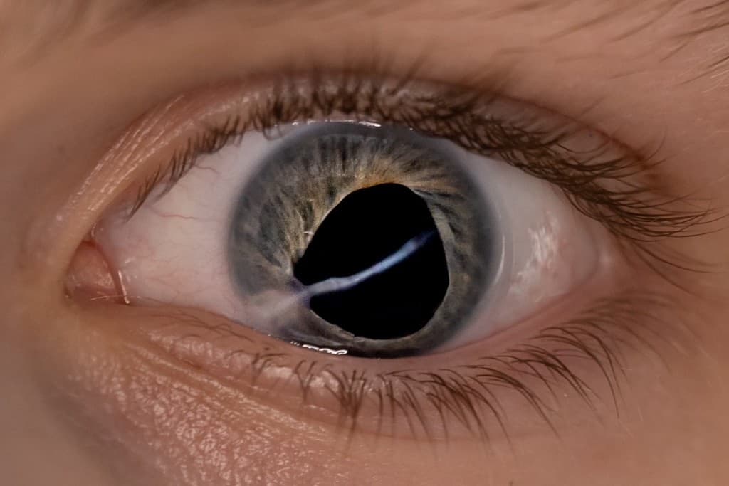 Clinical close-up of Branson's injured eye showing iris and corneal damage