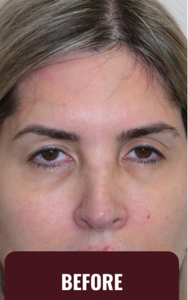 Before ZipLyft procedure