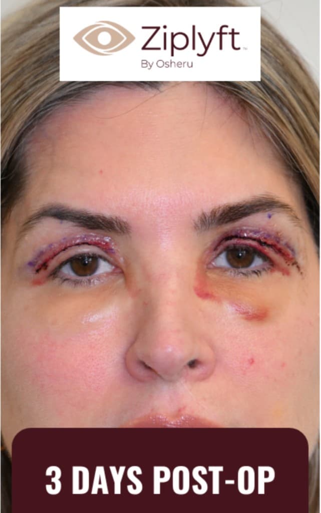 Three days post-op after ZipLyft